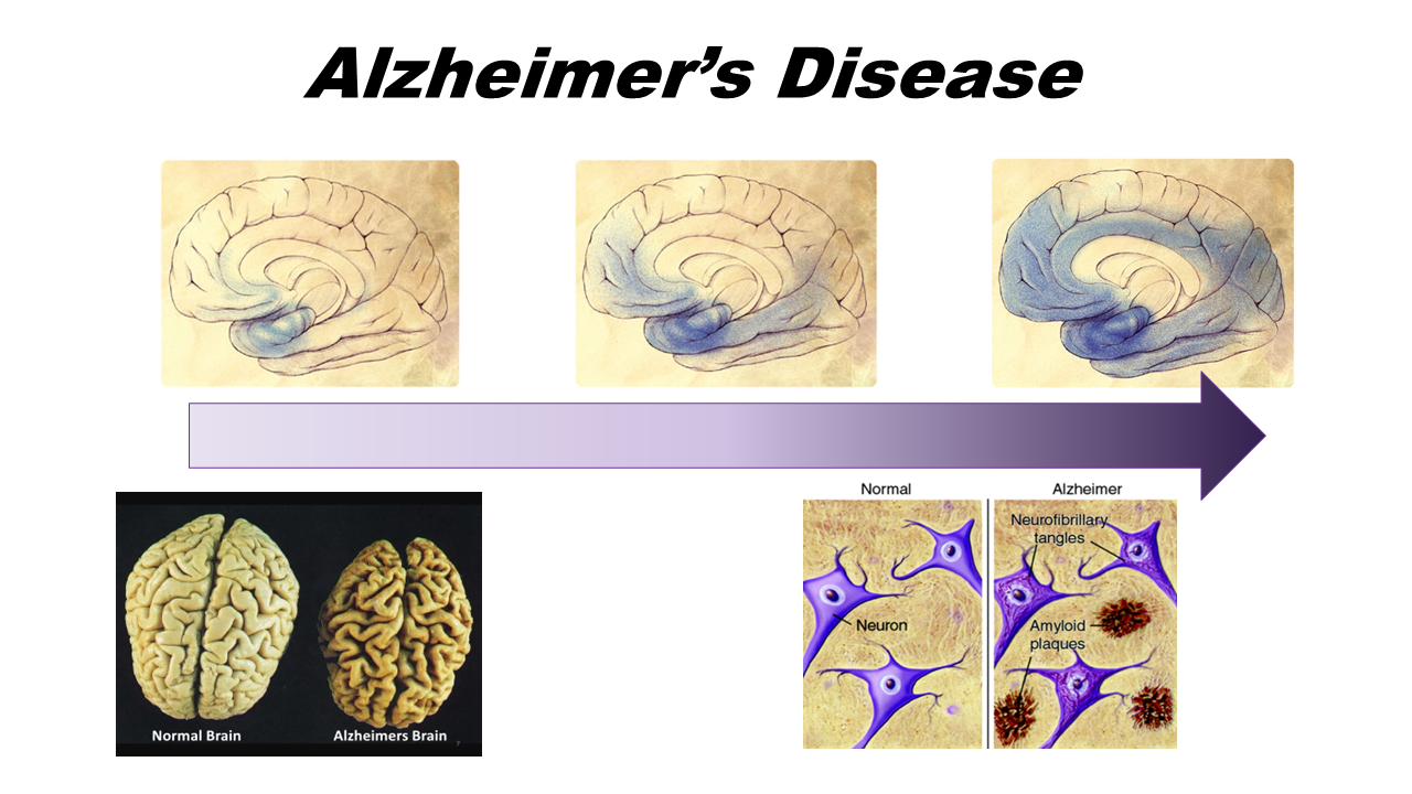 Graphic representation of the process of Alzheimer's Disease on the brain