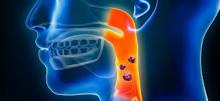 A x-ray of throat cancer